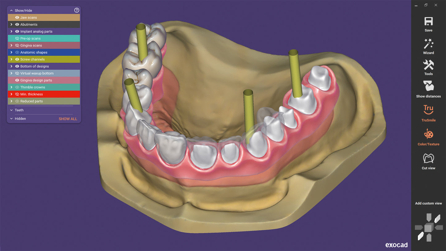 DentalCAD-flex: Implant Bundle