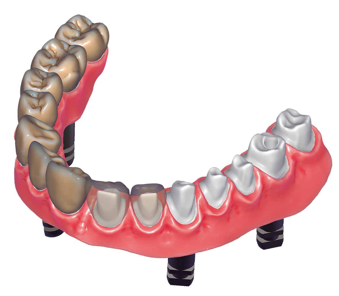 DentalCAD-flex: Implant Bundle