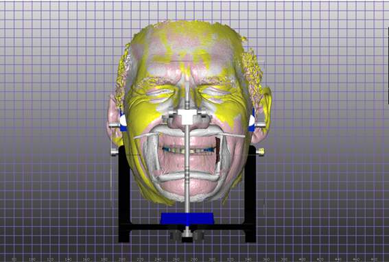 Exocad 3D Facially Generated Smile Design